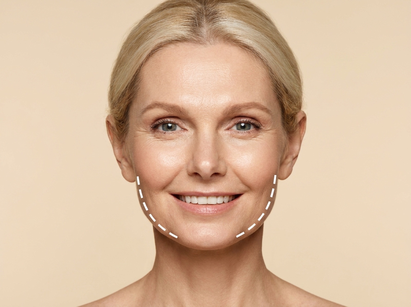 Jowls Filler