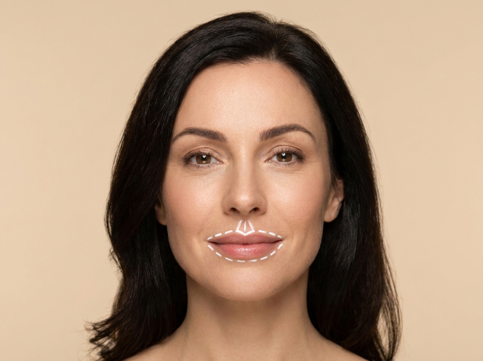 Lip Filler
