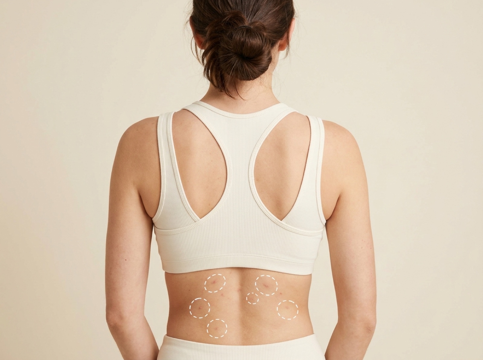 Acne Treatment — Lower Back