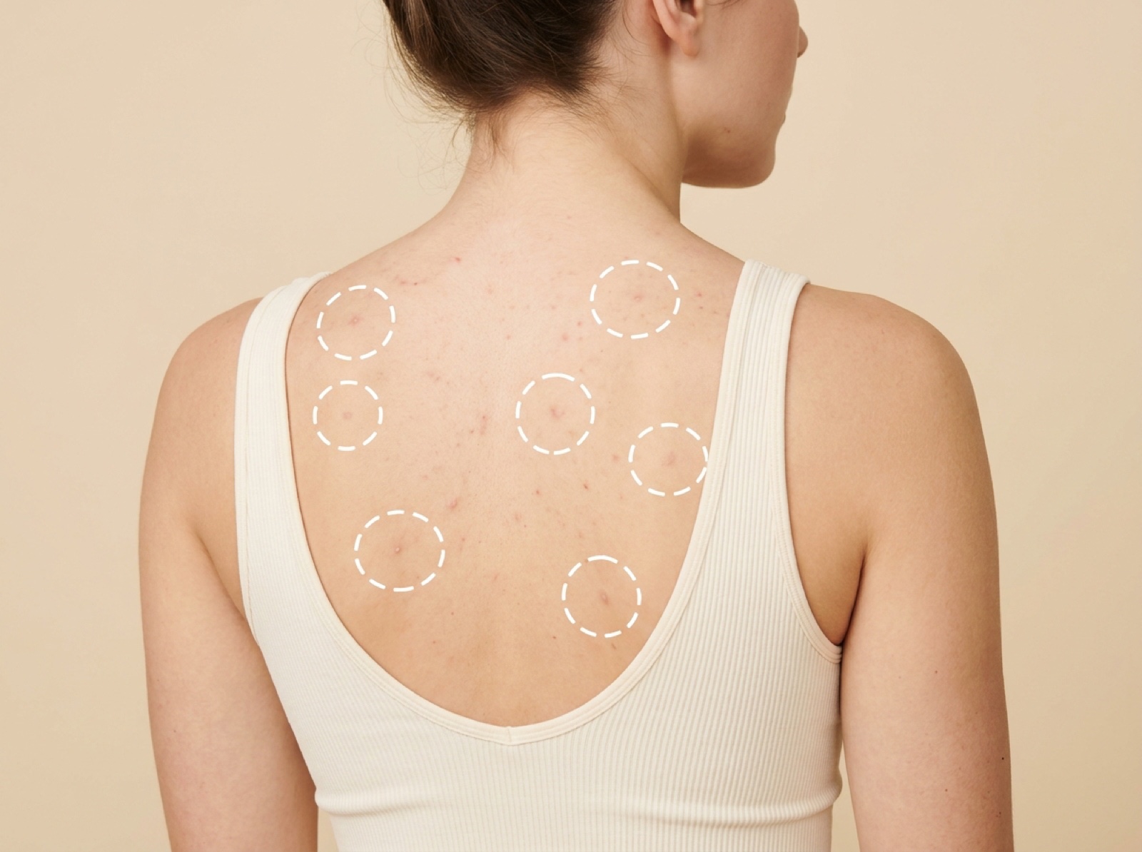Acne Treatment — Upper Back and Chest