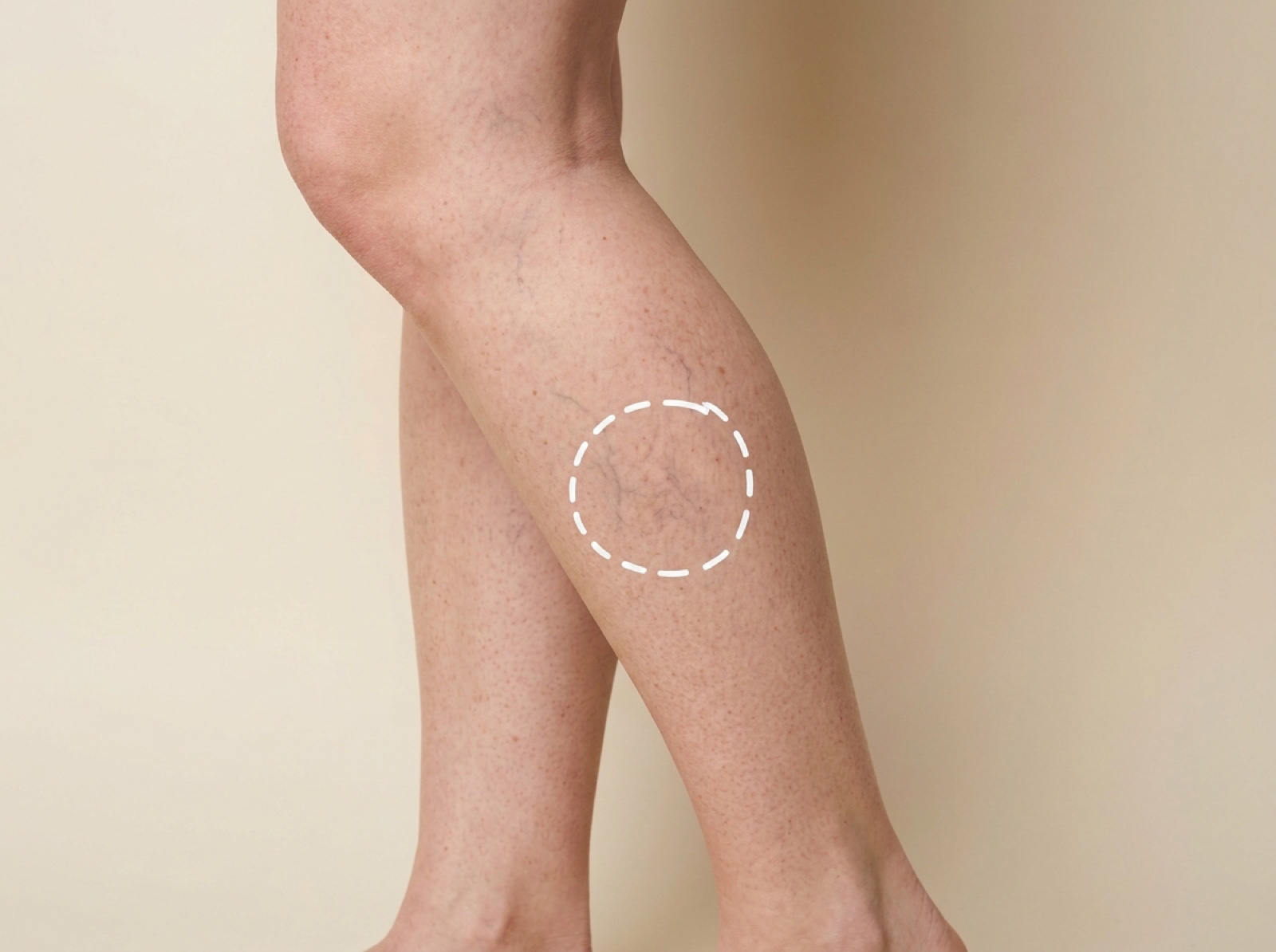 Vascular Laser